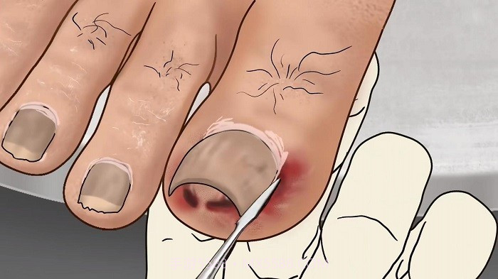 修脚足疔模拟器正版v1.0截图