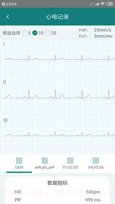 及时心电截图2 及时心电截图2