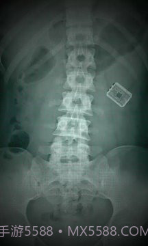 X射线扫描器胃截图3 X射线扫描器胃截图3