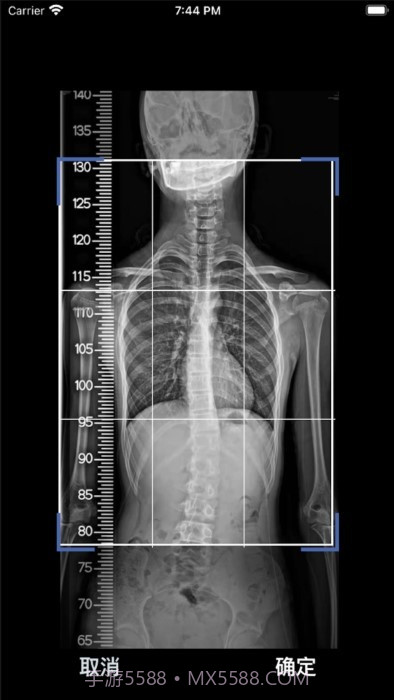 cobb角测量分析平台截图1 cobb角测量分析平台截图1