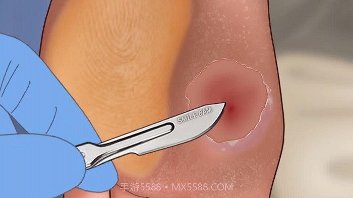 修脚足疔模拟器去更新版截图3